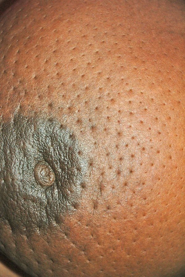 kanker payudara tanpa op/kemo